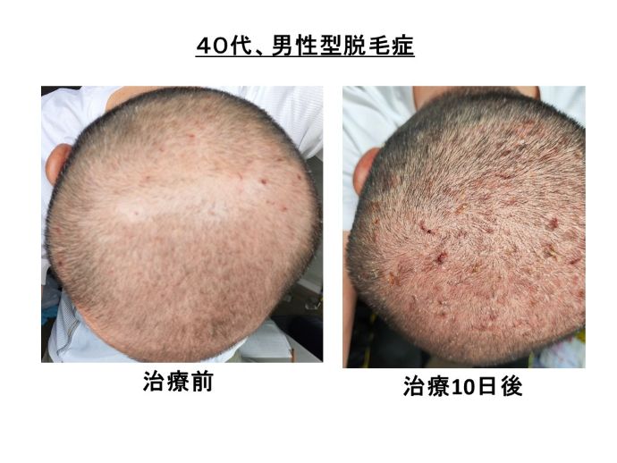円形脱毛症　病院